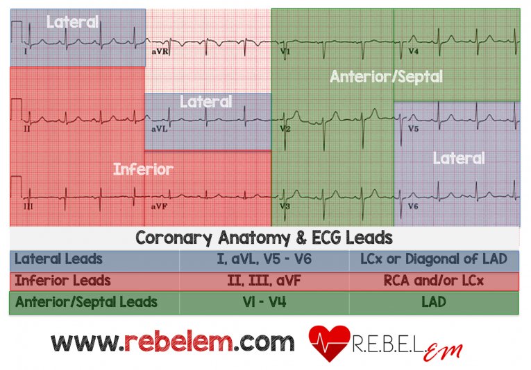 Twelve-lead electrocardiogram with lead groups shaded: lateral leads I, aVL, V5 and V6 map to the circumflex or a diagonal of the left anterior descending; inferior leads II, III and aVF to the right coronary artery and/or circumflex; anterior and septal leads V1 to V4 to the left anterior descending.