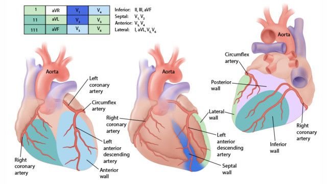 Three heart views mapping walls to arteries: anterior and septal walls to the left anterior descending, lateral and posterior walls to the circumflex, inferior wall to the right coronary artery, with a lead key: inferior II, III, aVF; septal V1, V2; anterior V3, V4; lateral I, aVL, V5, V6.