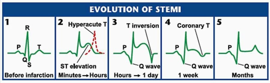 Five electrocardiogram complexes showing the evolution of an ST-elevation infarction: normal before infarction; hyperacute T and ST elevation within minutes to hours; ST elevation with T inversion and a Q wave within hours to a day; a Q wave with a coronary T at one week; a persistent Q wave at months.