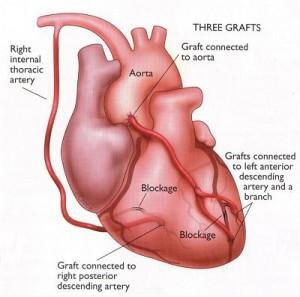 Heart with three bypass grafts: a right internal thoracic artery graft, grafts connected to the aorta, and grafts to the left anterior descending artery and a branch and to the right posterior descending artery, beyond marked blockages.