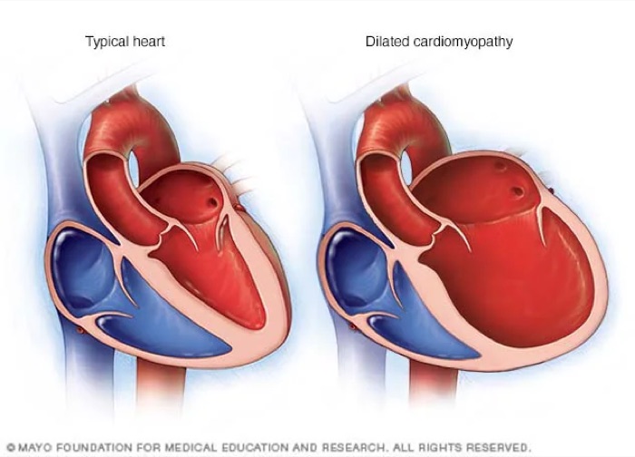 Cut-away of a typical heart beside a dilated cardiomyopathy heart with an enlarged, thin-walled left ventricle.