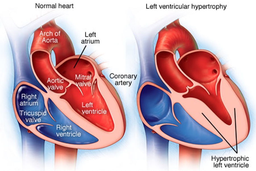 Cut-away of a normal heart beside one with left ventricular hypertrophy, the left ventricular wall thickened and the cavity small.