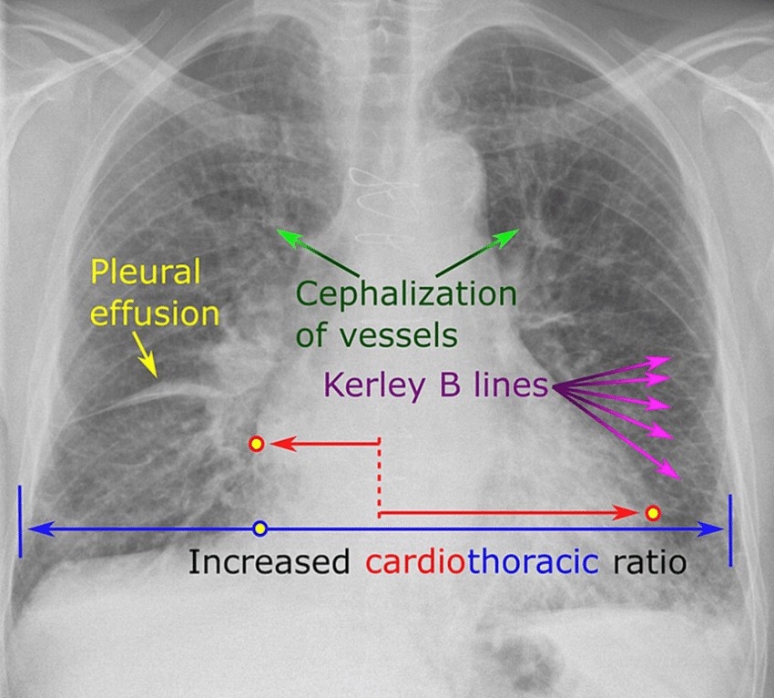 Annotated chest radiograph of heart failure labeling pleural effusion, cephalization of vessels, Kerley B lines and an increased cardiothoracic ratio.