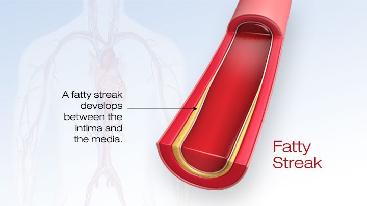 Fatty streak developing between the intima and the media of an artery.