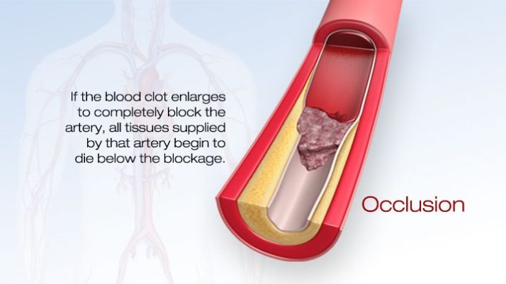Clot enlarging to occlude the artery; tissue below the blockage dies.