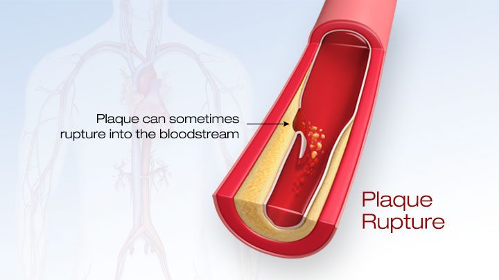 Plaque rupturing into the bloodstream.
