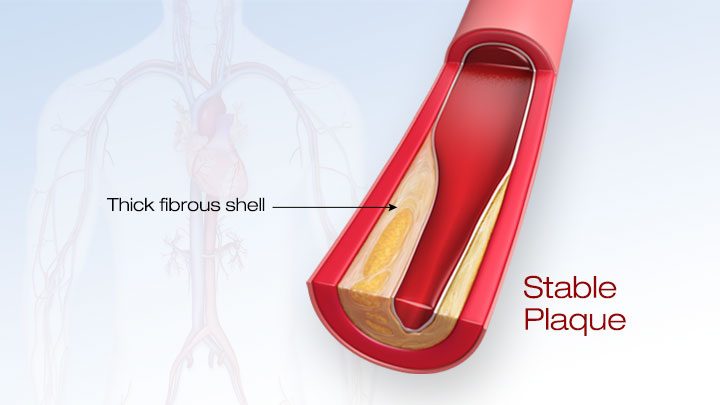Stable plaque with a thick fibrous shell.