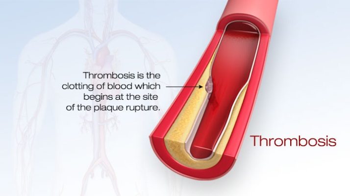 Thrombosis beginning at the site of plaque rupture.