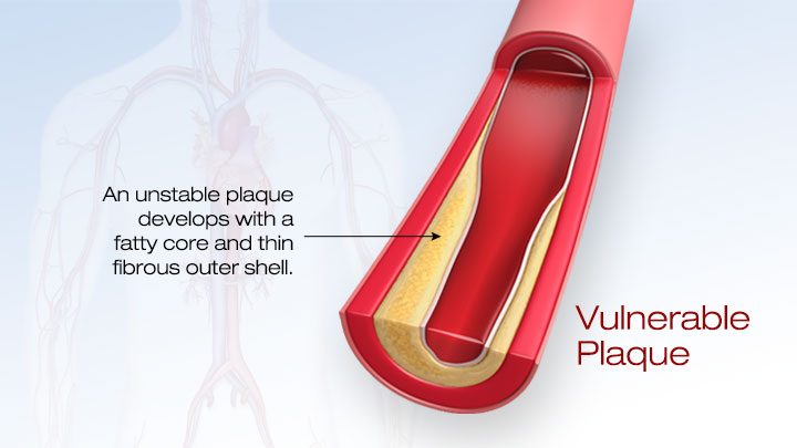 Vulnerable plaque with a fatty core and a thin fibrous outer shell.