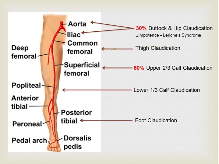 Leg arterial diagram mapping claudication site to arterial level: aorta and iliac to buttock and hip (30%, with impotence in Leriche syndrome), common femoral to thigh, superficial femoral to upper two-thirds of calf (60%), popliteal to lower third of calf, tibial to foot.