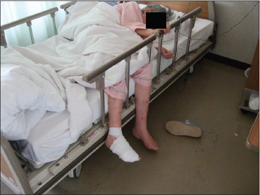 Patient lying in bed with both legs hanging over the edge to relieve rest pain.