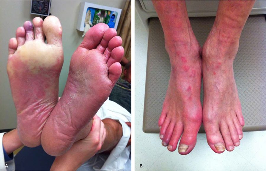 Two clinical photographs: A, soles of both feet with one sole pale on elevation; B, both feet hanging down and red-purple.