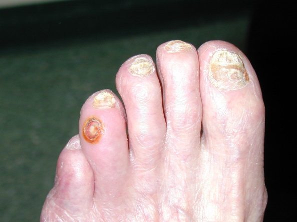 Small round punched-out ulcer on a toe with dystrophic nails.