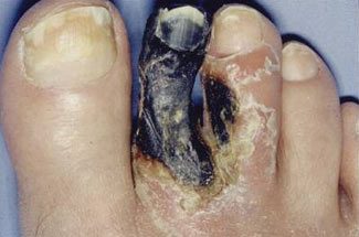 Black, shriveled, mummified toe with a sharp line of demarcation.