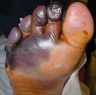 Swollen purple-black forefoot and toes with moist skin.