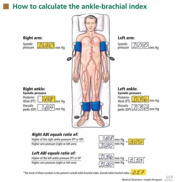 Cleveland Clinic figure showing how to calculate the ankle-brachial index from arm and ankle systolic pressures; the lower leg value is the overall index.