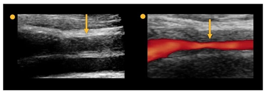 Duplex ultrasound: grayscale and color Doppler panels showing the same arterial stenosis with a narrowed flow column.