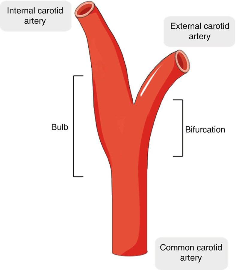 Carotid anatomy: common carotid, bifurcation, bulb, internal and external carotid arteries.