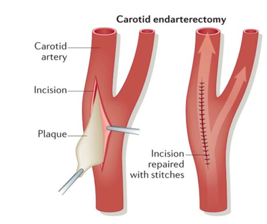 Carotid endarterectomy: incision in the carotid artery, plaque removed, incision repaired with stitches.
