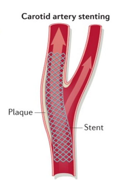 Carotid artery stenting: a stent placed across plaque at the carotid bifurcation.