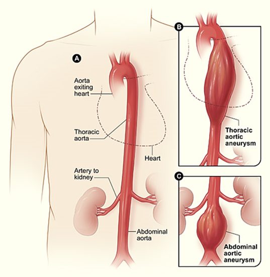 Figure lettered A normal aorta, B thoracic aortic aneurysm, C abdominal aortic aneurysm below the renal arteries.