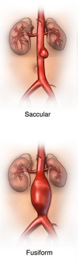 Two renderings of an infrarenal aorta: a saccular side outpouching above and a fusiform whole-circumference dilation below.