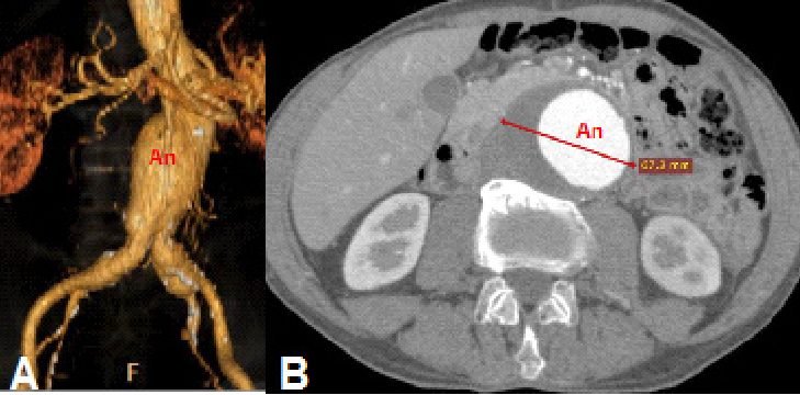 Computed tomography angiography: A three-dimensional rendering of an infrarenal abdominal aortic aneurysm; B axial image with the aneurysm measured.