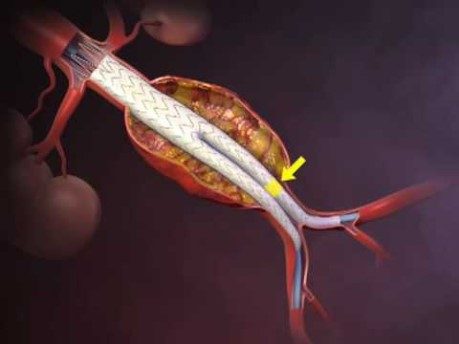 Animation still of a bifurcated stent graft inside an abdominal aortic aneurysm sac.