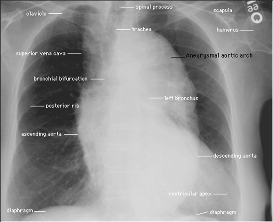 Labeled chest X-ray showing an aneurysmal aortic arch widening the mediastinum.