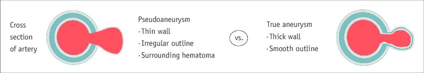 Cross-section comparison: pseudoaneurysm with thin wall, irregular outline and surrounding hematoma versus true aneurysm with thick wall and smooth outline.