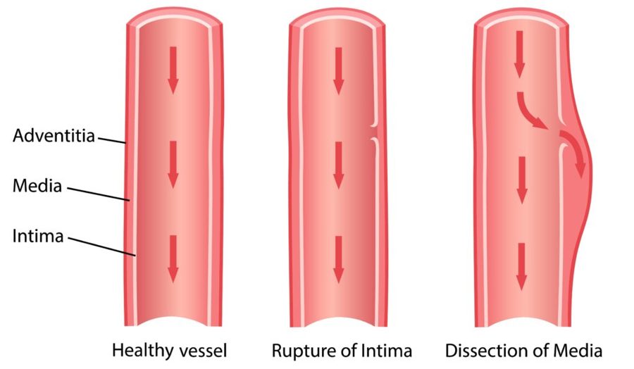Three vessels: healthy wall layers, rupture of the intima, then blood dissecting into the media.