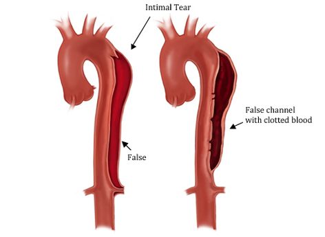 Two aortas: an intimal tear with a false lumen along the descending aorta, and a false channel with clotted blood.