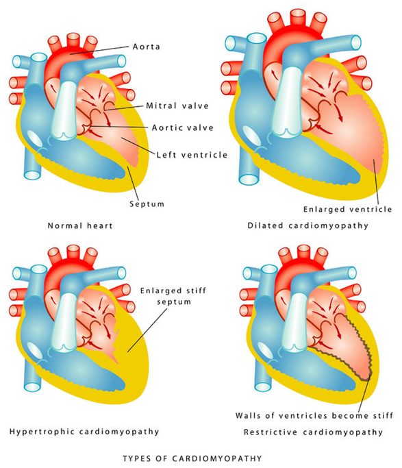 Four panels: normal heart; dilated cardiomyopathy with an enlarged ventricle; hypertrophic cardiomyopathy with an enlarged stiff septum; restrictive cardiomyopathy with stiff ventricular walls.