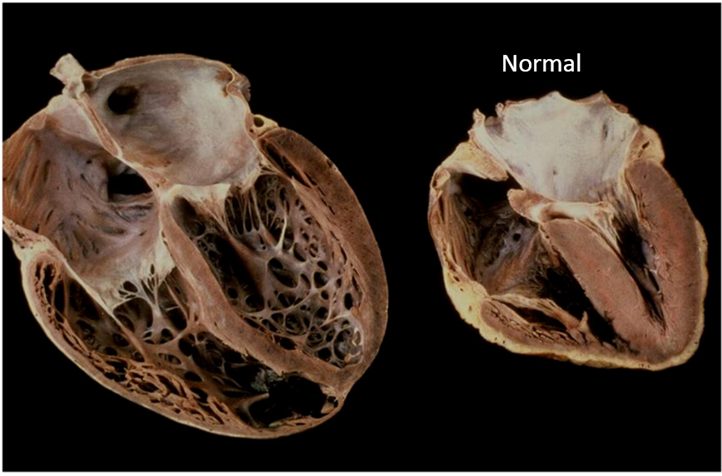 Gross pathology: a bisected globular dilated heart beside a normal heart.