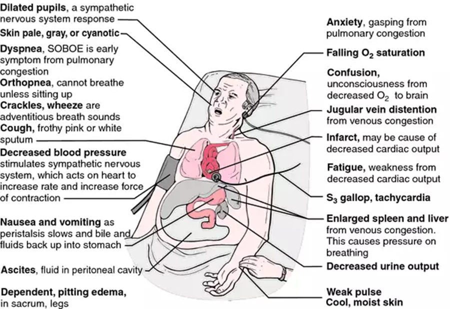 Labeled drawing of a patient in heart failure listing signs from dilated pupils and cyanosis to pitting edema, jugular venous distension, S3 gallop, enlarged liver and spleen, decreased urine output and cool moist skin.