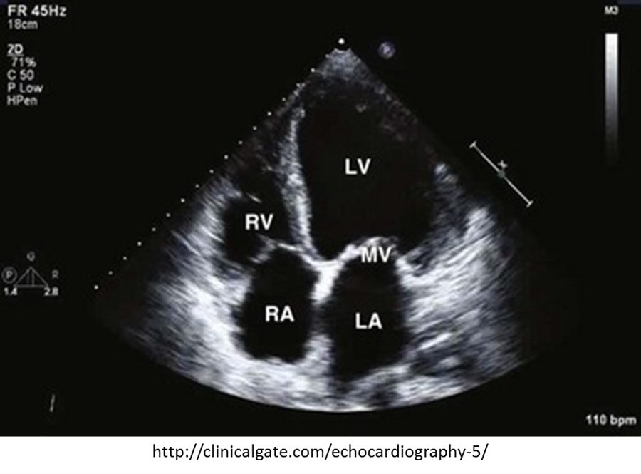 Apical four-chamber echocardiogram with a large dilated left ventricle.