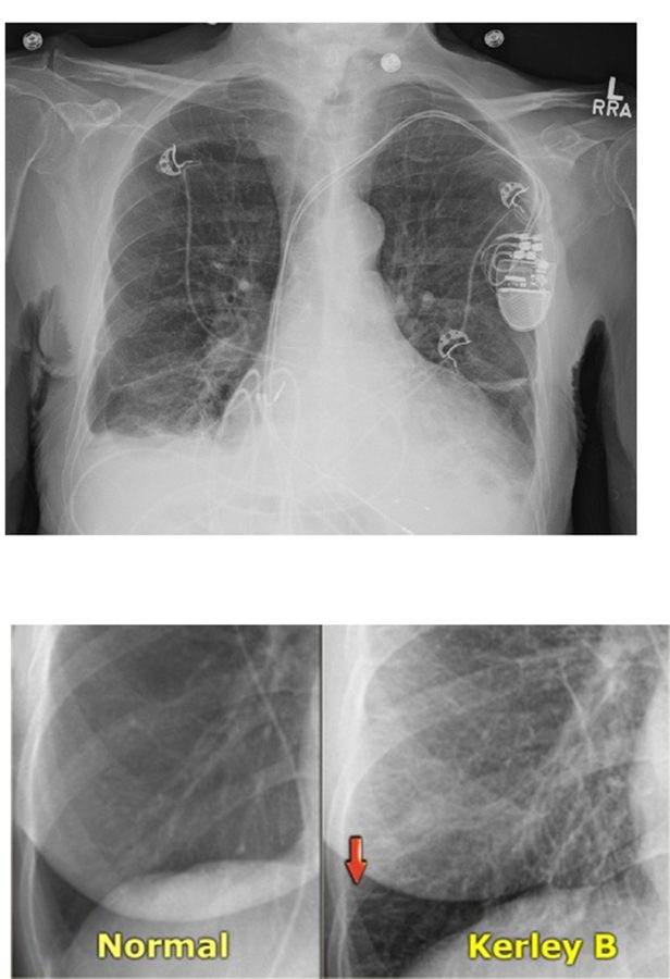 Chest radiograph with cardiomegaly and an inset pair: normal lung periphery on the left, Kerley B lines on the right.