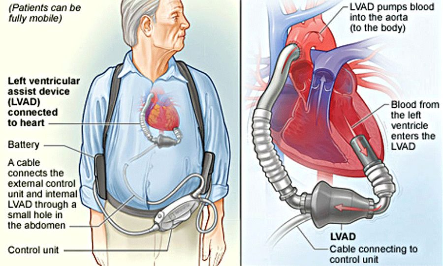 Left ventricular assist device: pump connected to the left ventricle delivering blood to the aorta, with a cable through the abdomen to an external control unit and battery.