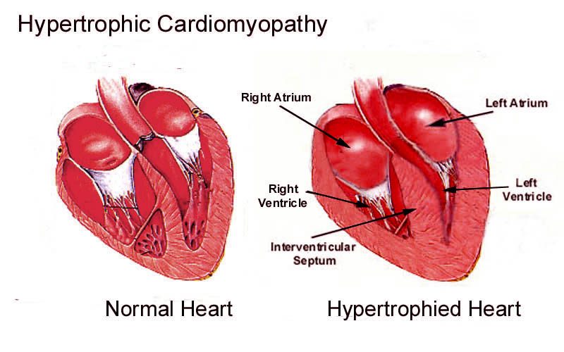 Normal heart beside a hypertrophied heart with a thick interventricular septum and left ventricle.