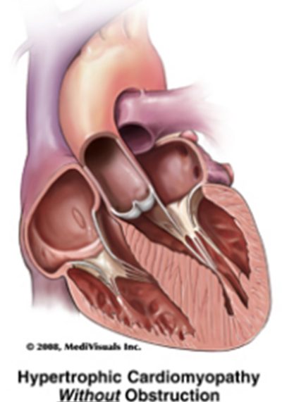 Hypertrophic cardiomyopathy without obstruction: thick walls with an open outflow tract.