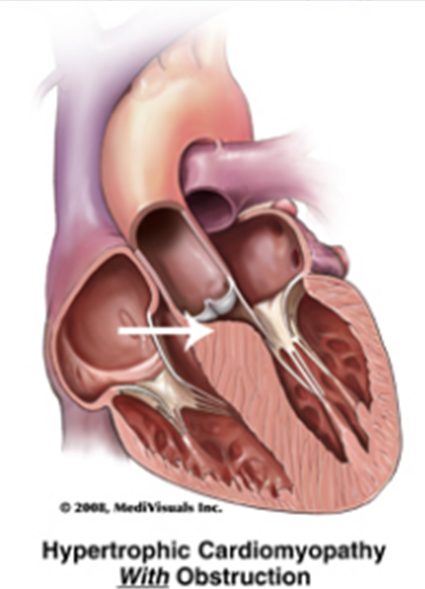Hypertrophic cardiomyopathy with obstruction: septal bulge narrowing the outflow tract below the aortic valve.