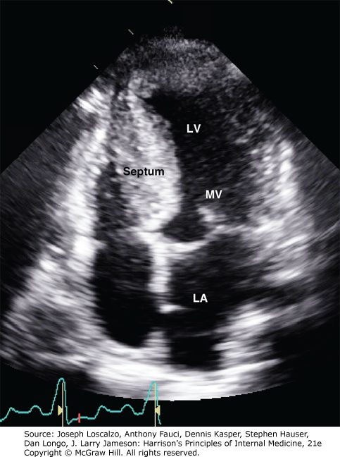 Echocardiogram showing a thick septum and small left ventricular cavity.