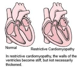 Normal heart beside restrictive cardiomyopathy: stiff, not necessarily thickened ventricular walls.