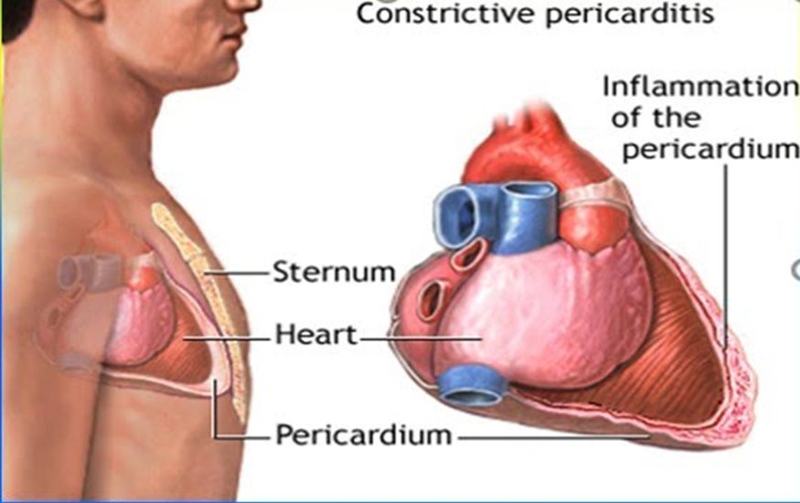 Illustration of constrictive pericarditis: inflamed pericardium around the heart.