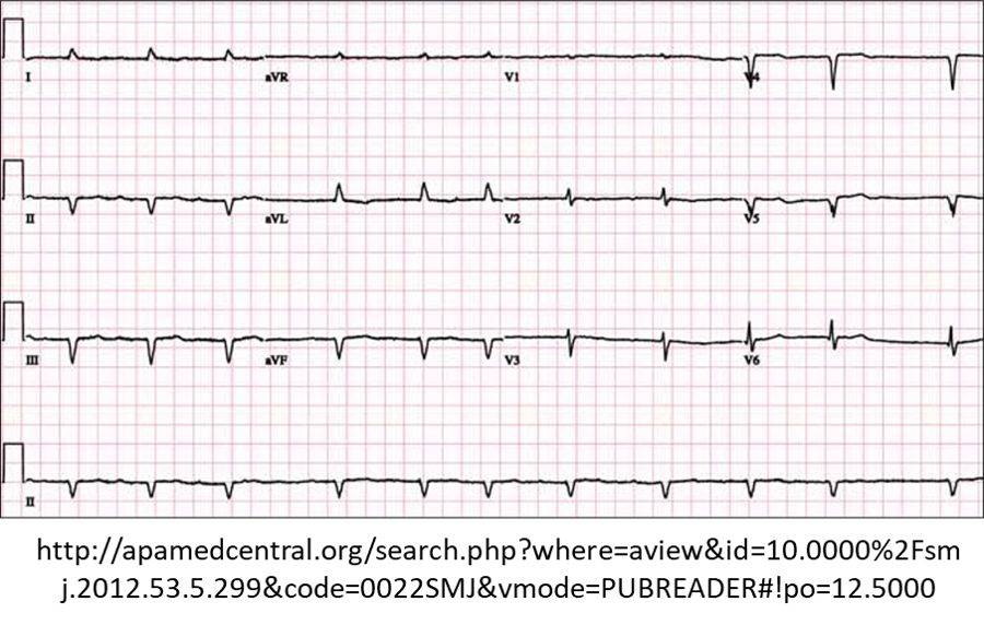 Twelve-lead electrocardiogram with very low QRS voltage in all leads.