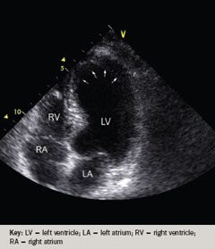 Apical echocardiogram with arrows outlining a ballooned, akinetic left ventricular apex.