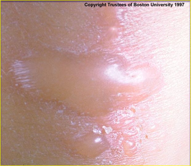Gross clinical or pathological specimen illustrating the serous pattern of inflammation.