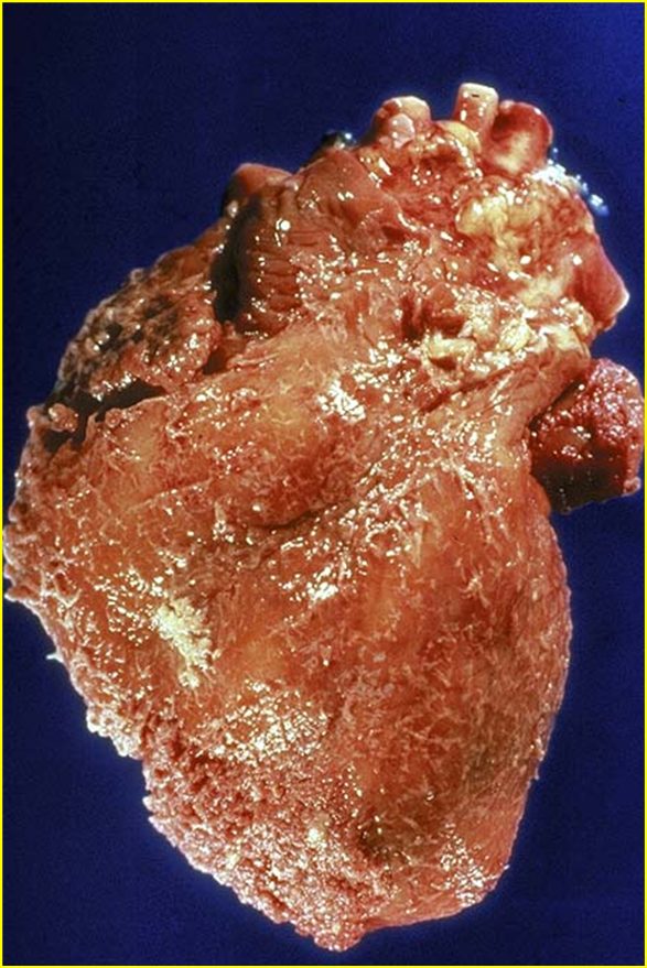 Gross clinical or pathological specimen illustrating the fibrinous pattern of inflammation.