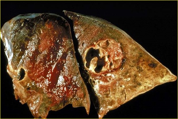 Gross clinical or pathological specimen illustrating the suppurative (purulent) pattern of inflammation.
