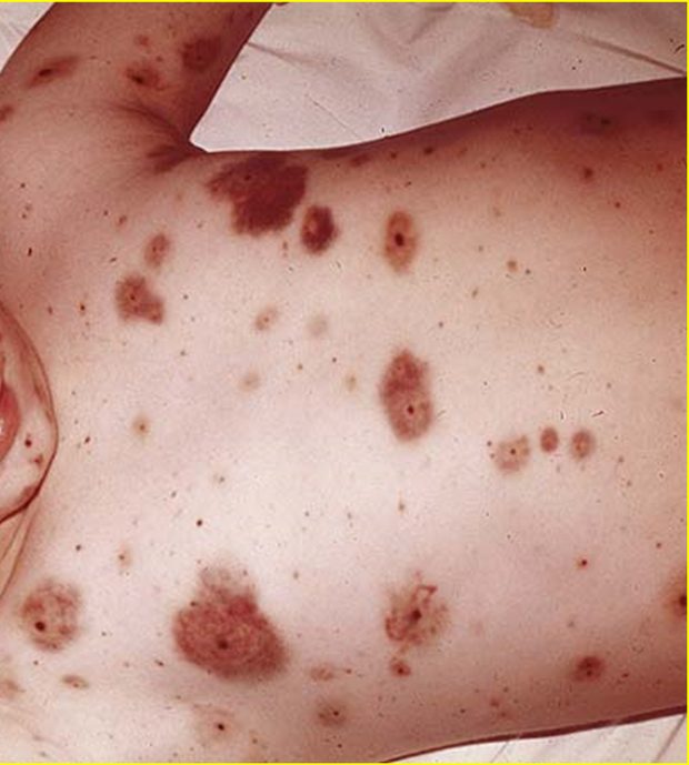Gross clinical or pathological specimen illustrating the hemorrhagic pattern of inflammation.